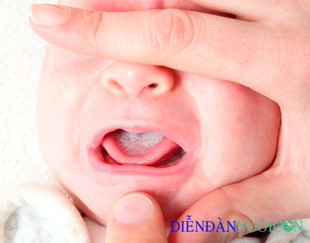 Bệnh nấm lưỡi ở trẻ em