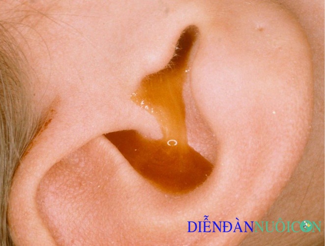Viêm tai giữa chảy mủ do bục màng nhĩ